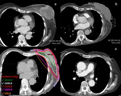 Case report: Ultrahypofractionated palliative breast radiotherapy for a fungating invasive mammary carcinoma